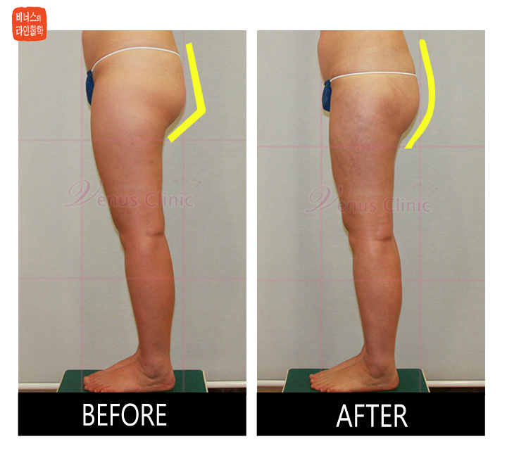 buttocks liposuction1_1.jpg