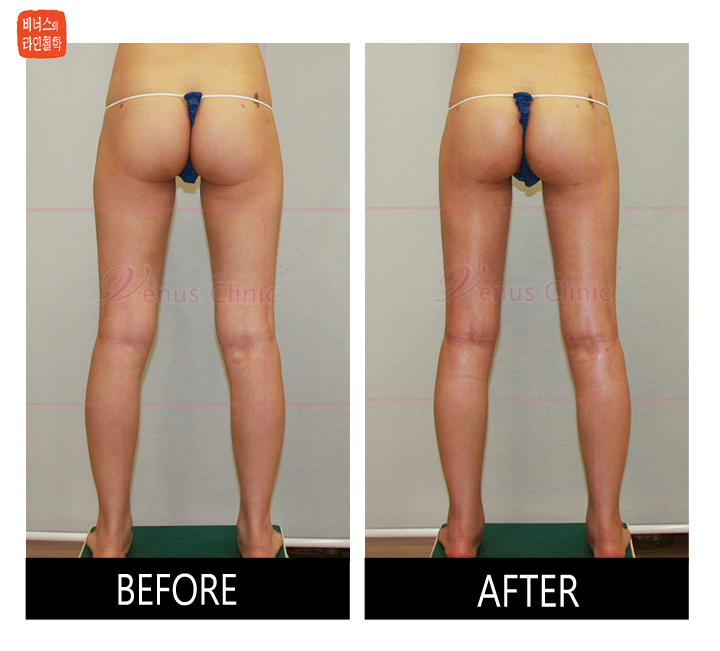 buttocks liposuction6.jpg