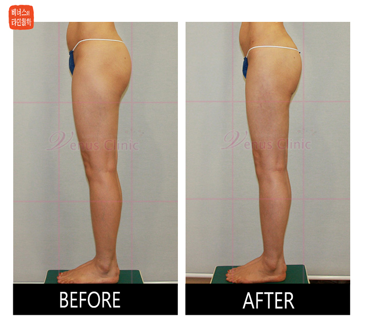 buttocks liposuction8.jpg