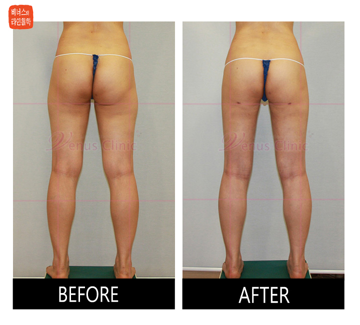 buttocks liposuction9.jpg