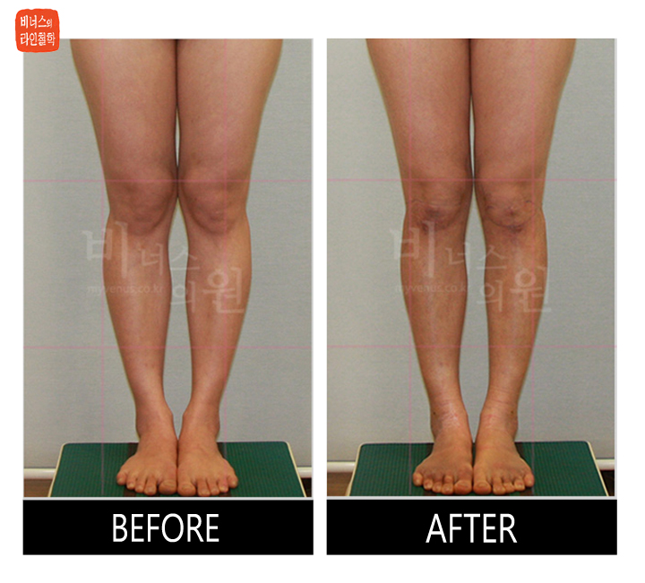 before and after of calf liposuction9