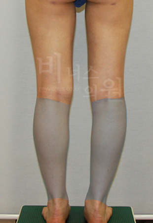 design of calf liposuction3