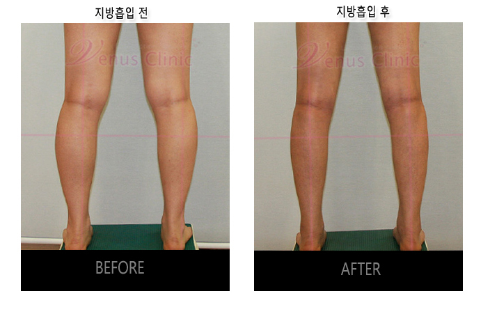 before and after of calf liposuction5