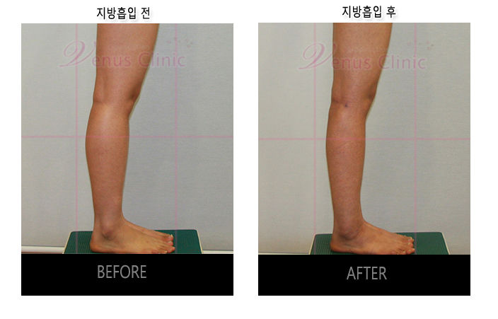 before and after of calf liposuction3