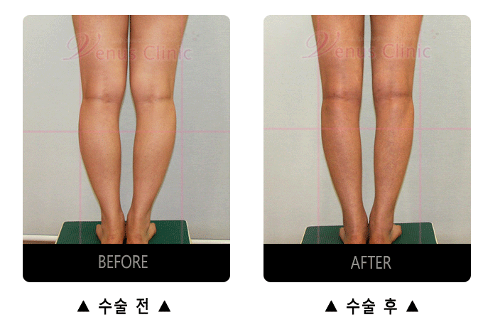 effects of calf liposuction2