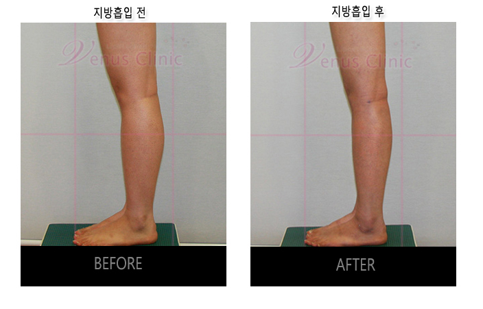 before and after of calf liposuction2