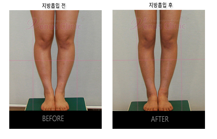 before and after of calf liposuction1
