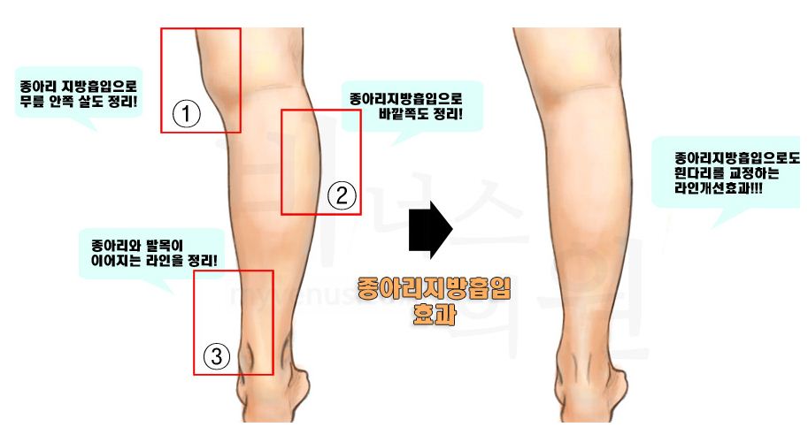effects of calf liposuction