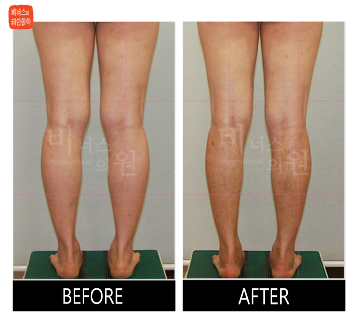 before and after of calf liposuction12