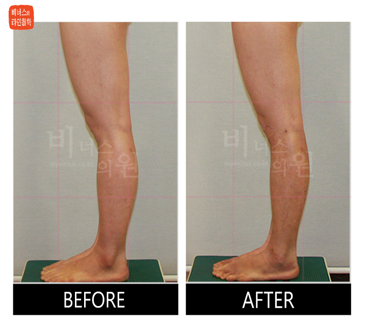 before and after of calf liposuction10