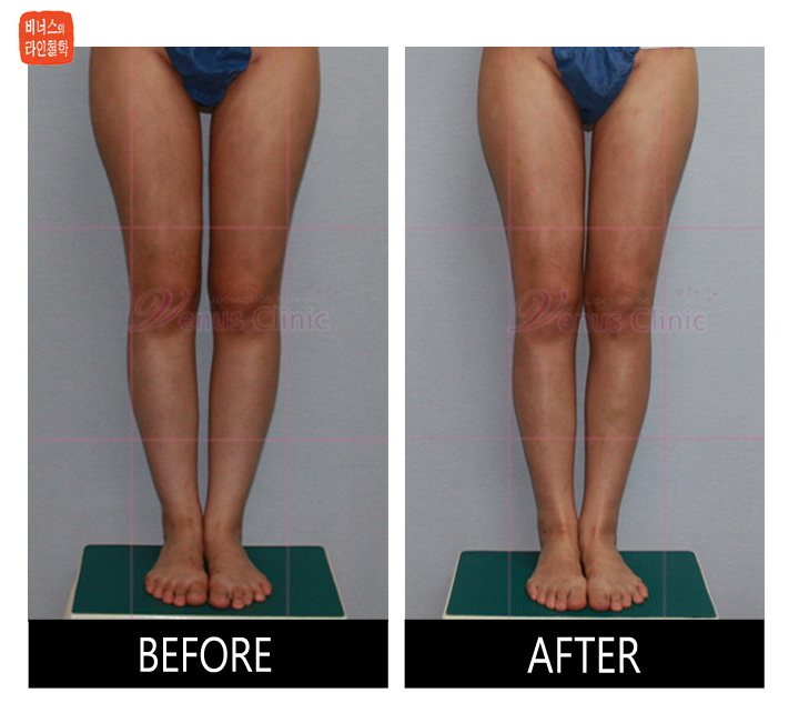 before and after of calf liposuction6