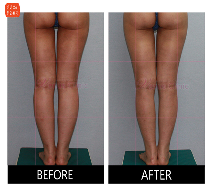 before and after of calf liposuction7
