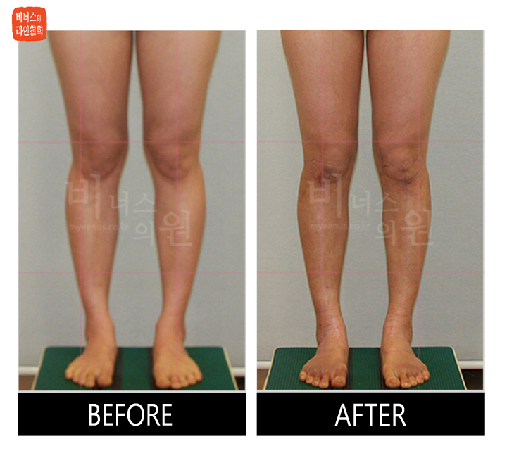 before and after of calf liposuction8