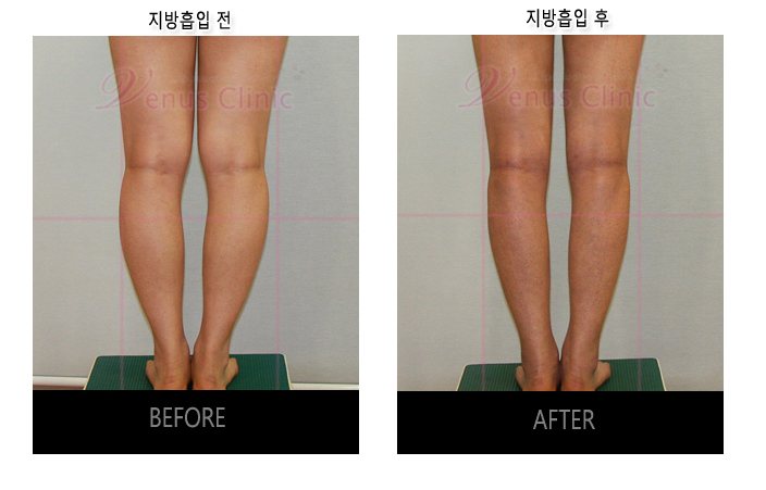 before and after of calf liposuction4