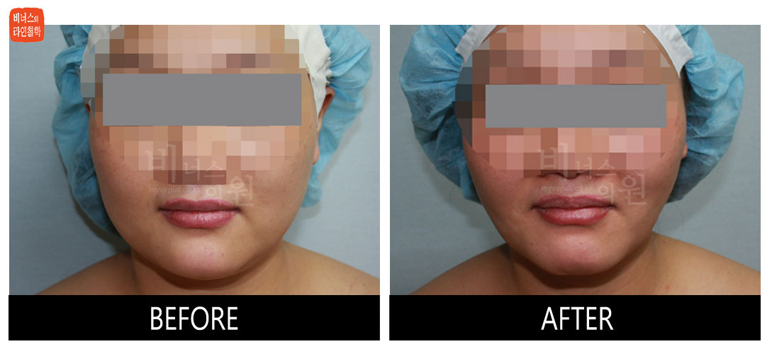 liposuction photos of face and neck4