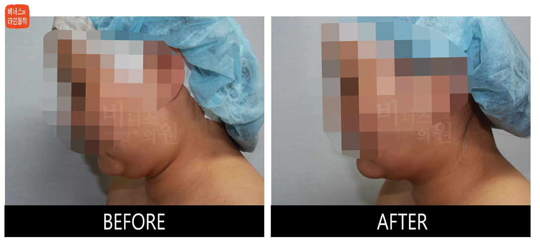 liposuction photos of face and neck6