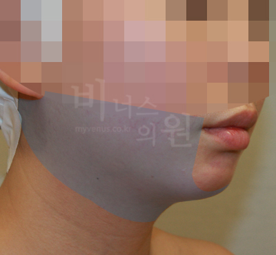 liposuction photos of face and neck1
