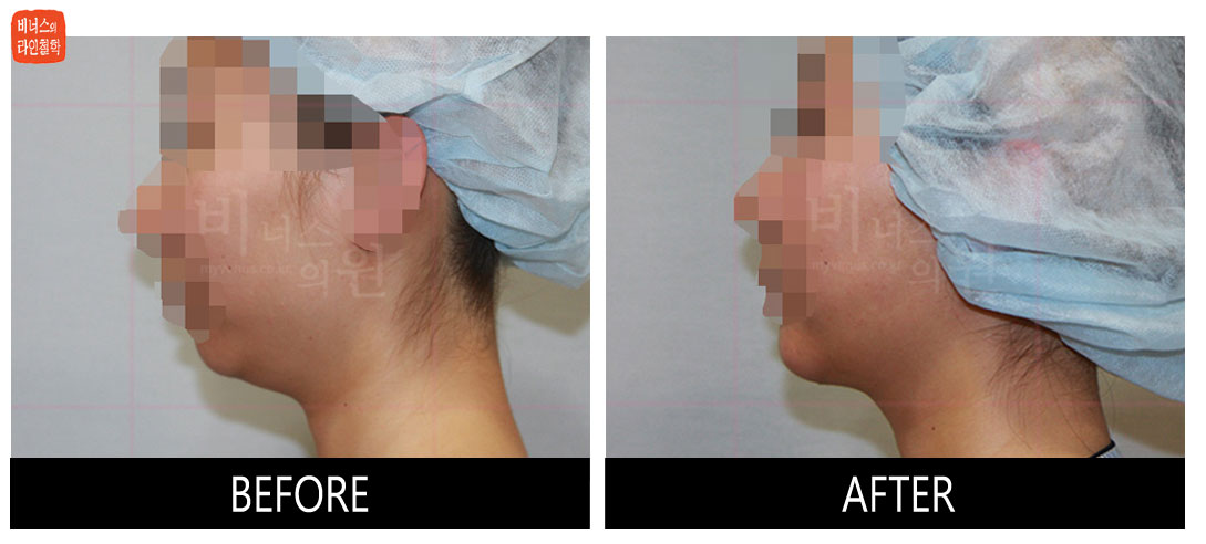 liposuction photos of face and neck12