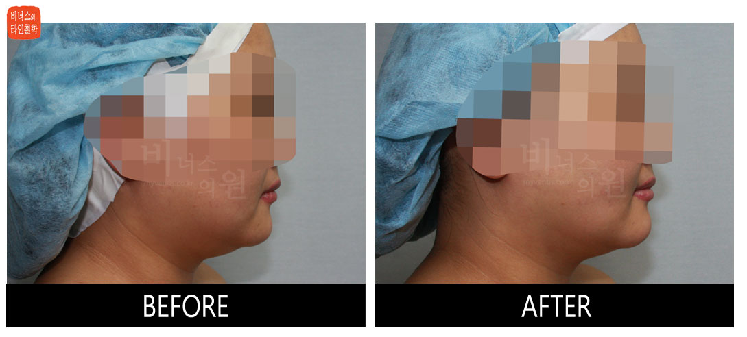 liposuction photos of face and neck5